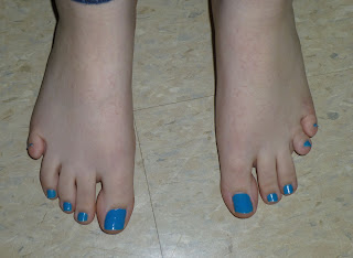 Toe Transfers | Congenital Hand and Arm Differences