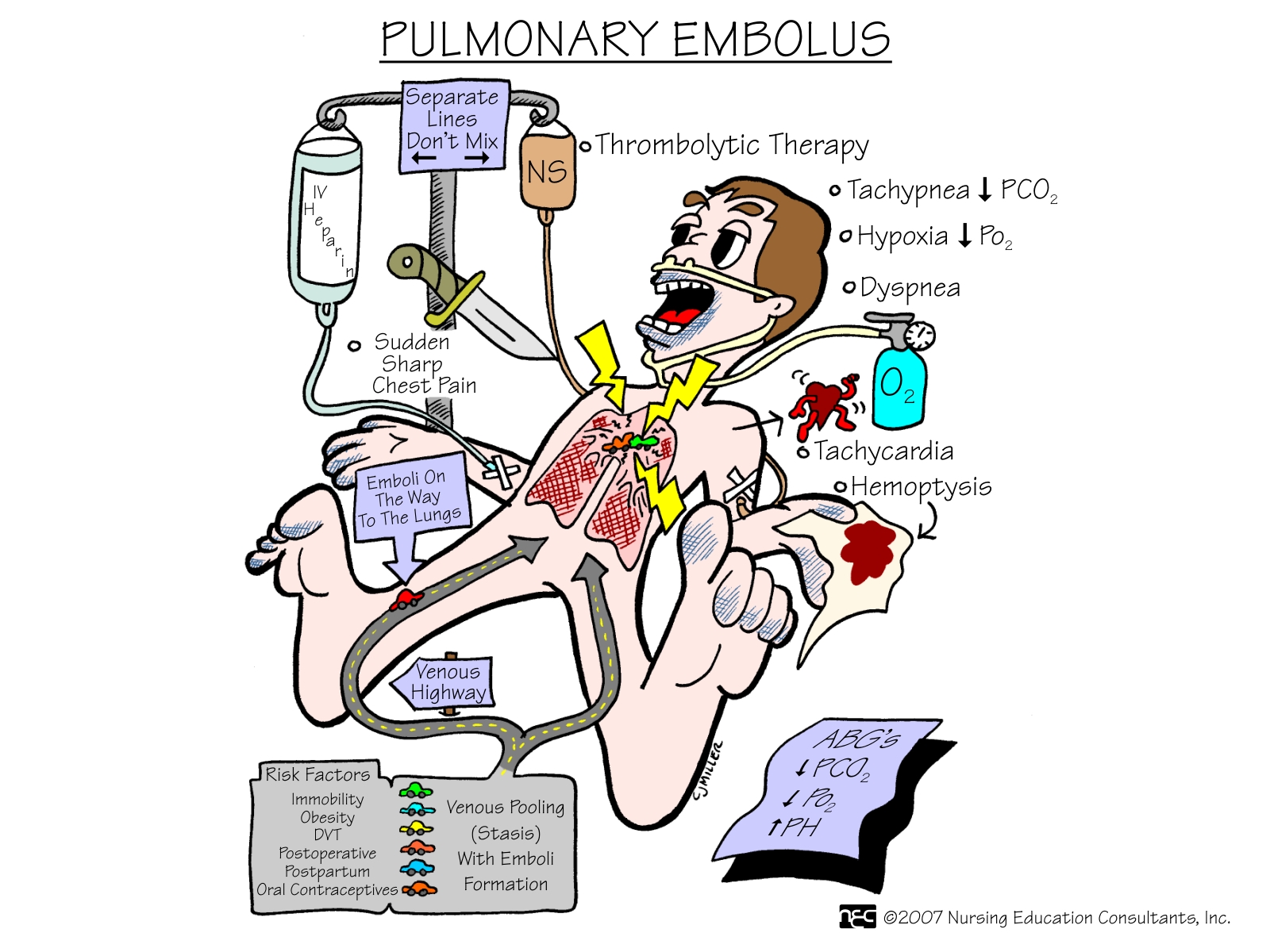 Pulmonary+Emboli Pulmonary+Emboli