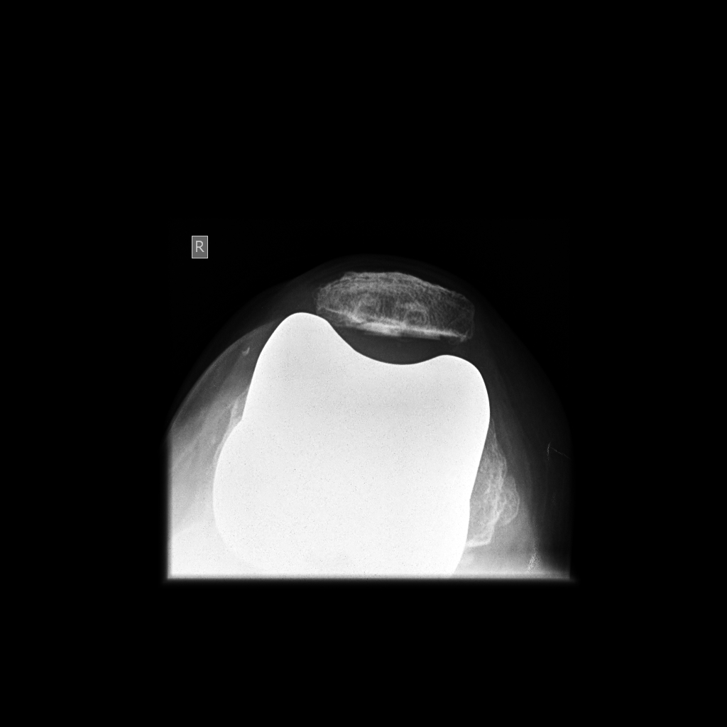 Joint Preservation and Replacement Patellar tilt in tkr