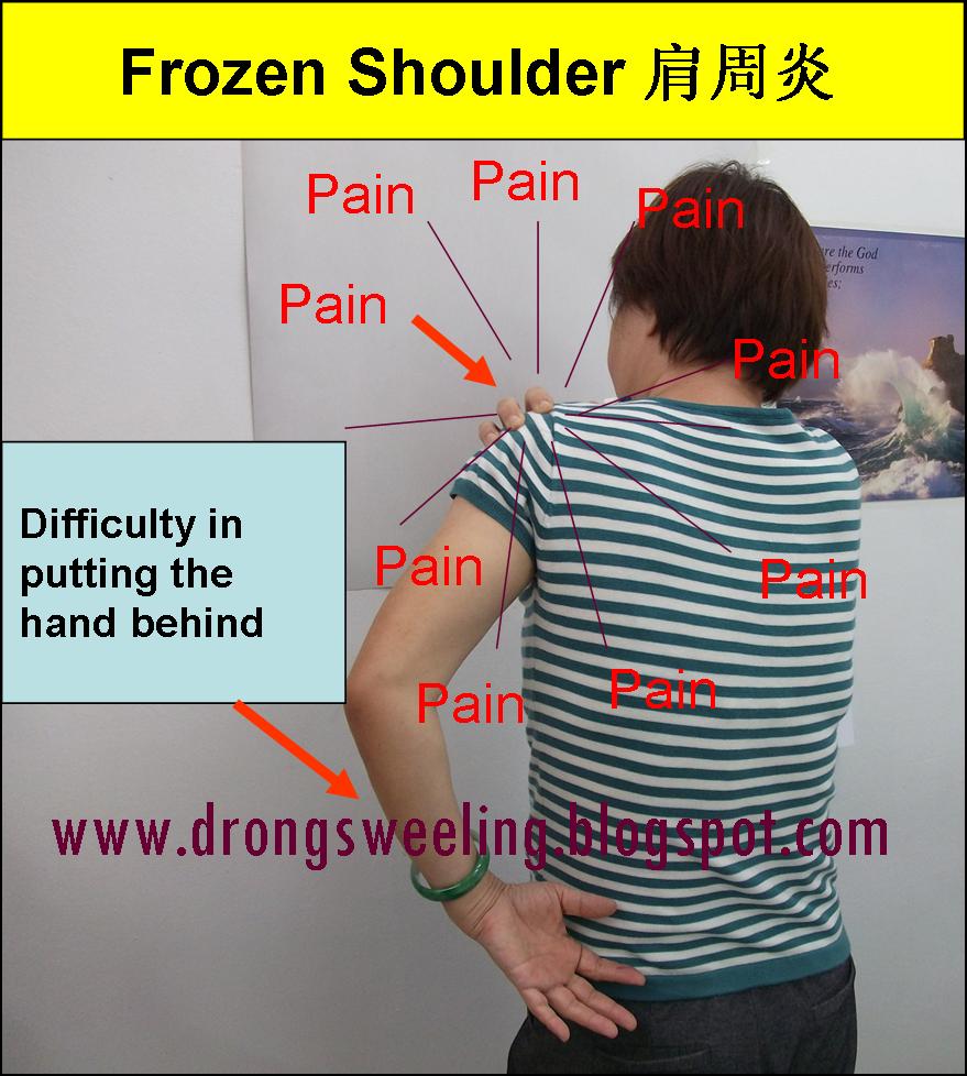 TCM News TCM and Frozen Shoulder