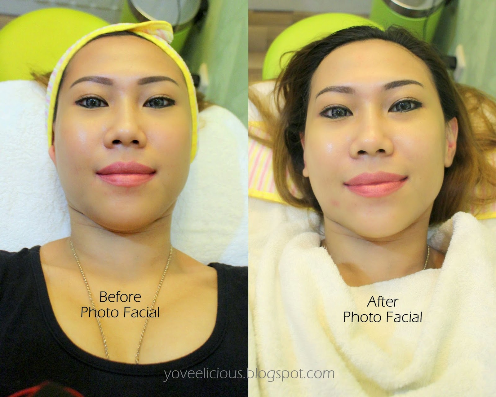 yoveelicious ZAP Photo Facial Review + Pictures