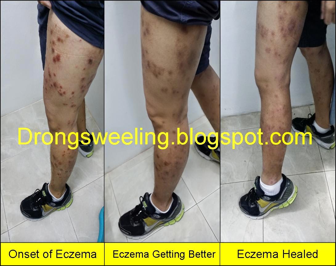 TCM News TCM Eczema Treatment for Eczema, Psoriasis, Best TCM Doctor