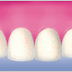 dents Beauté antérieure