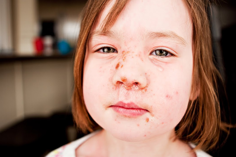 Happenings at Home Strep Face