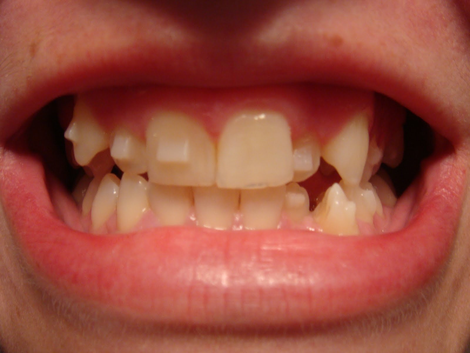 teeth bad week bottom maybe guess having them