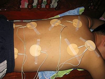 They reported that functional electrical stimulation therapy (FES) worked ... They reported that functional electrical stimulation therapy (FES) worked ...