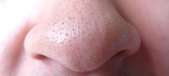 http://3.bp.blogspot.com/-BW9fku4Qpqg/Ub28nvMXX_I/AAAAAAAAAiQ/T05uYump5ys/s640/blackheads-nose.jpg
