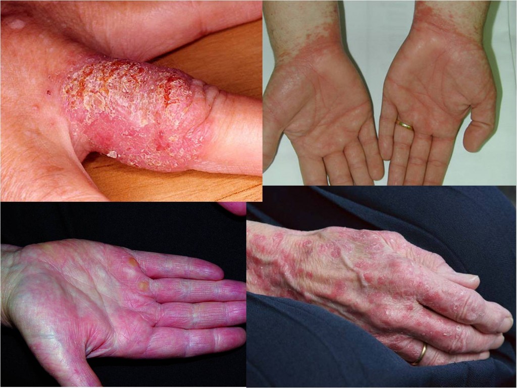 La psoriasis pustular el tratamiento