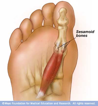Zweigeteiltes Sesambein Sesamoiditis