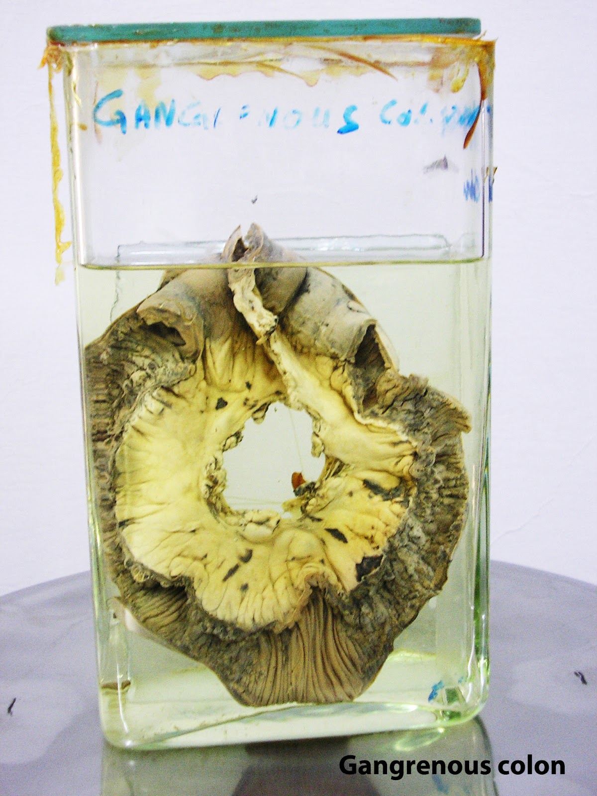 Medical Education for Students Gross Specimens General Pathology (50