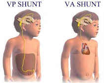 Different Types of Shunts