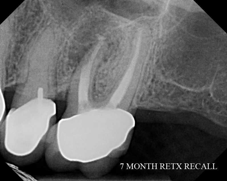 The Endo Blog Apical Surgery for Complete Endodontic Healing