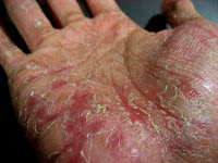 Seborrheic dermatitis steroid lotion
