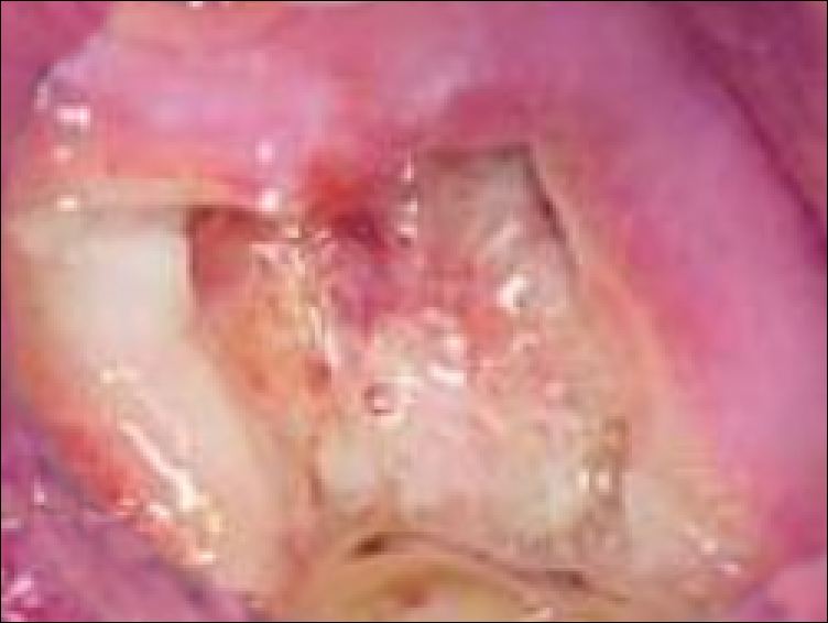 What Is A Dry Socket After A Tooth Is Extracted