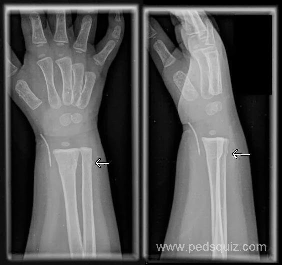 What is a buckle fracture of the wrist?