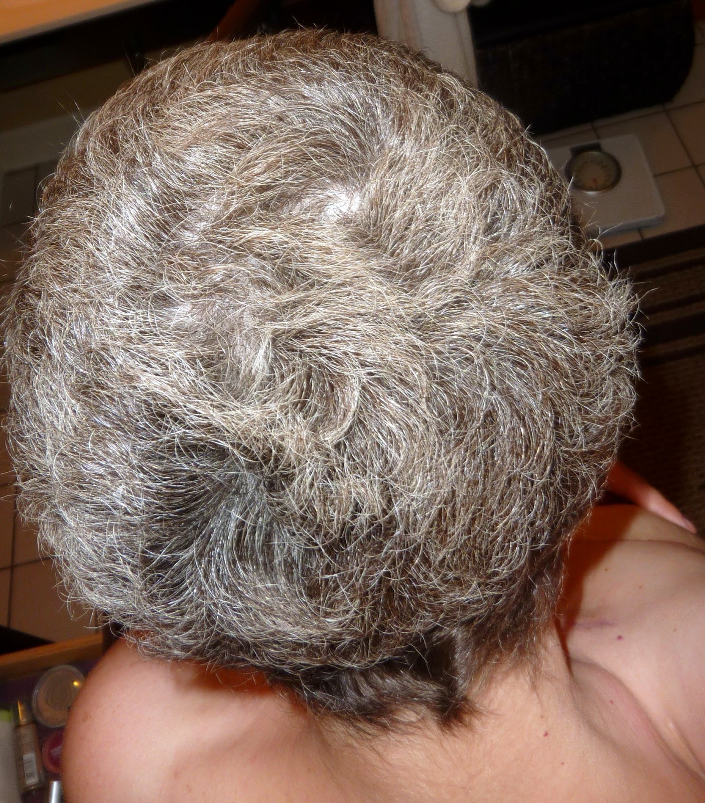 Anncredible: Hair Growth Progression after Chemo- Six Months with UPDATE!