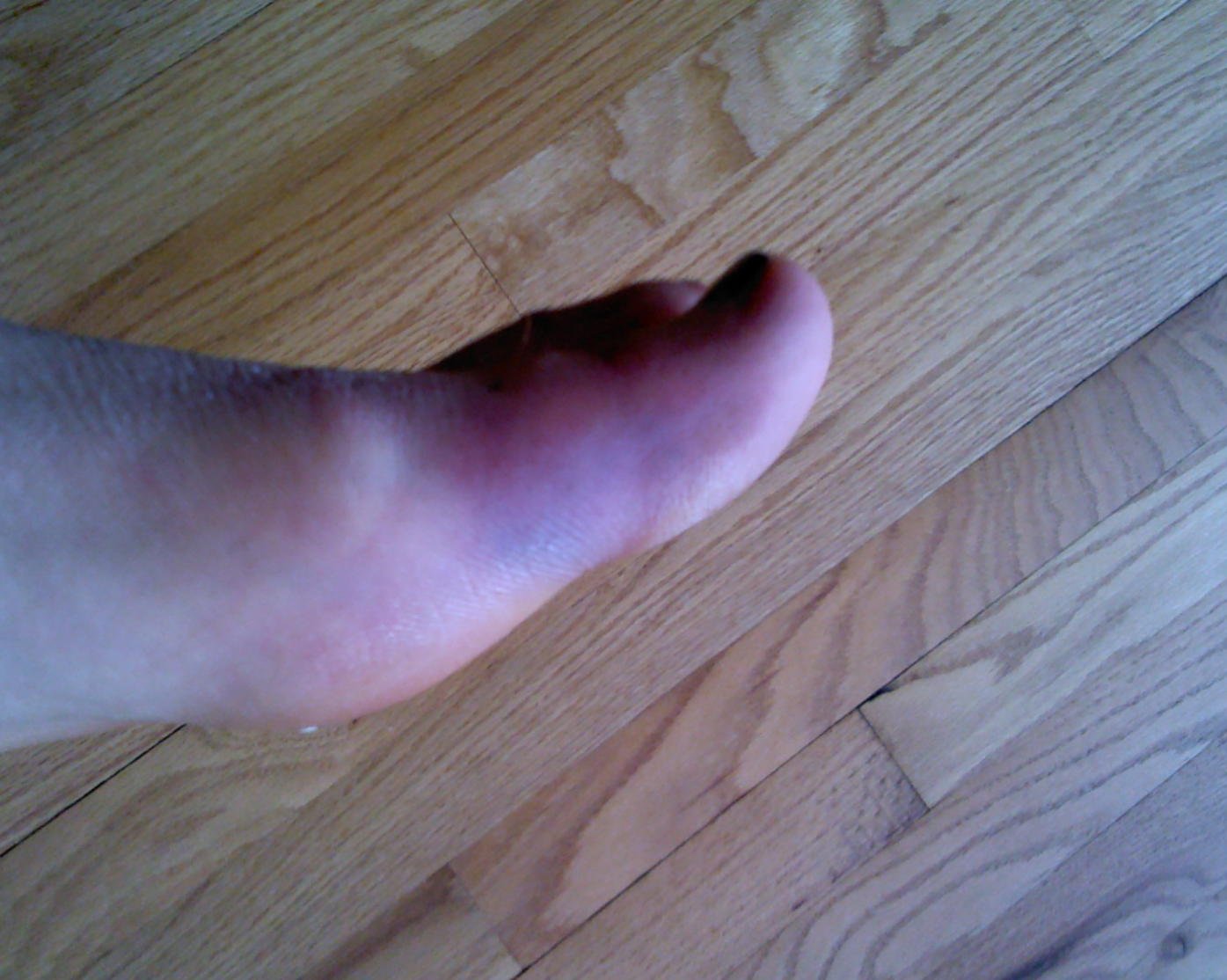 Whiskey and Lyme : Formication, Bruising & Biofilm