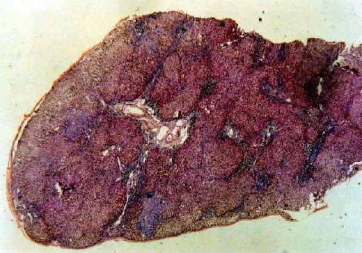 Выздоровление без лекарств: Цирроз излечим!