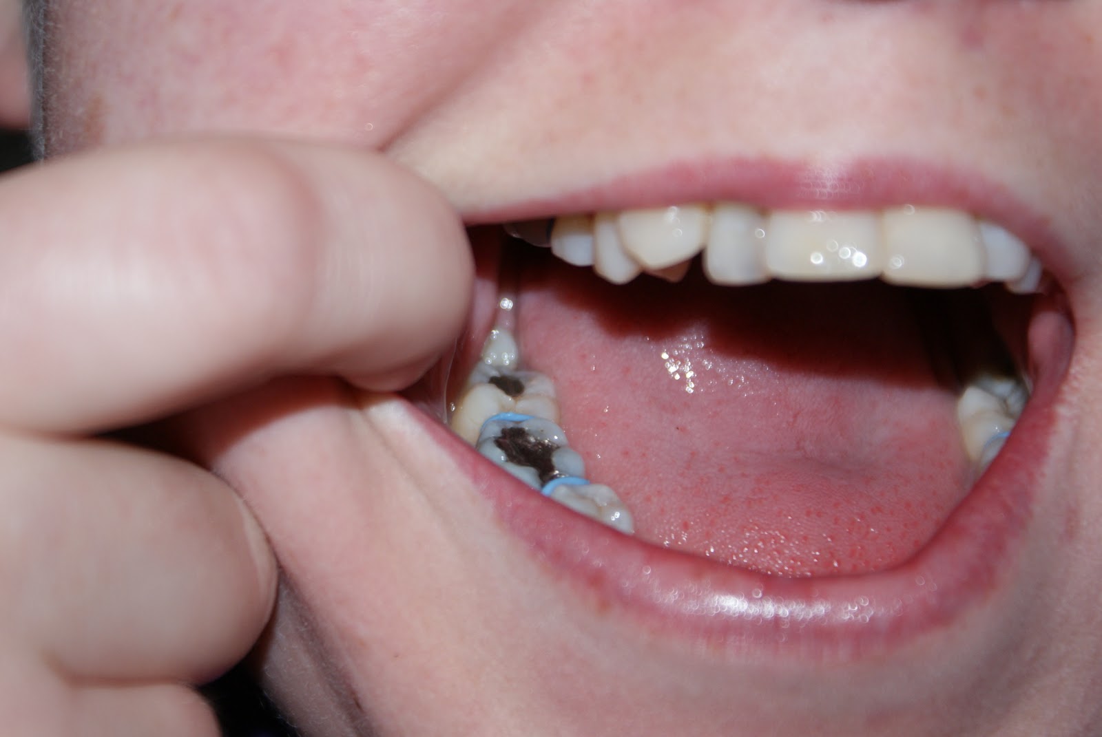 Braces + SARPE/SARME Surgery Spacers