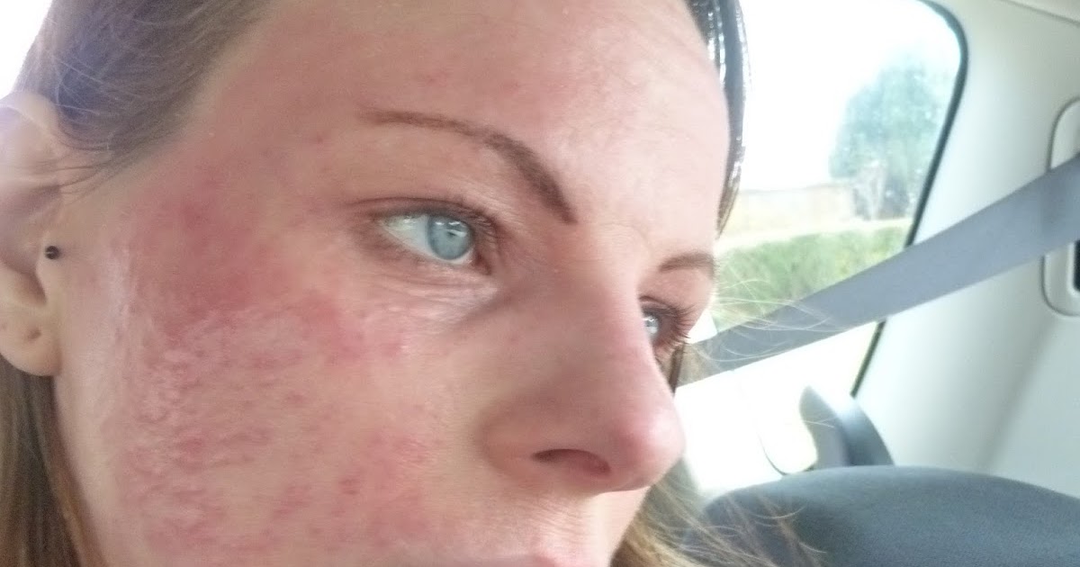 I Have Eczema Eczema Herpeticum & Being Given Wrong Medical Advice