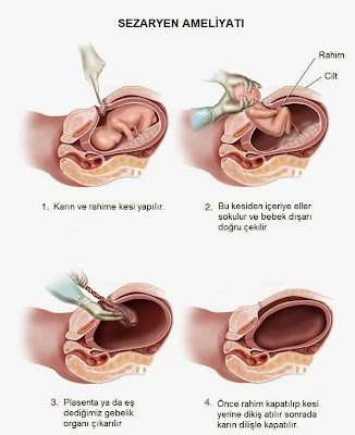 sezaryen doğum nasıl yapılır