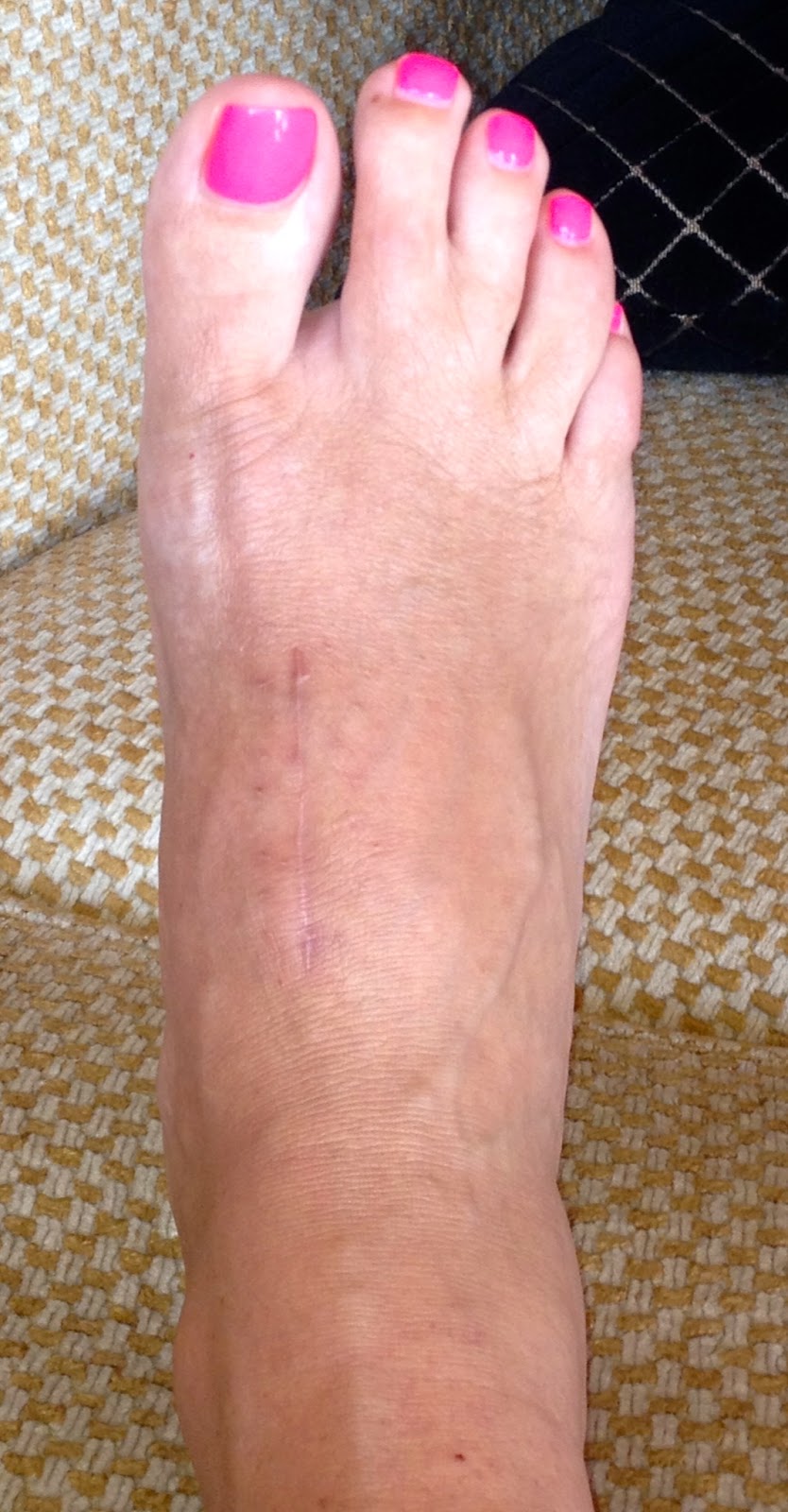 After LisFranc Surgery 15 weeks post lisfranc surgery