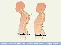 Kyphosis Lordosis Scoliosis