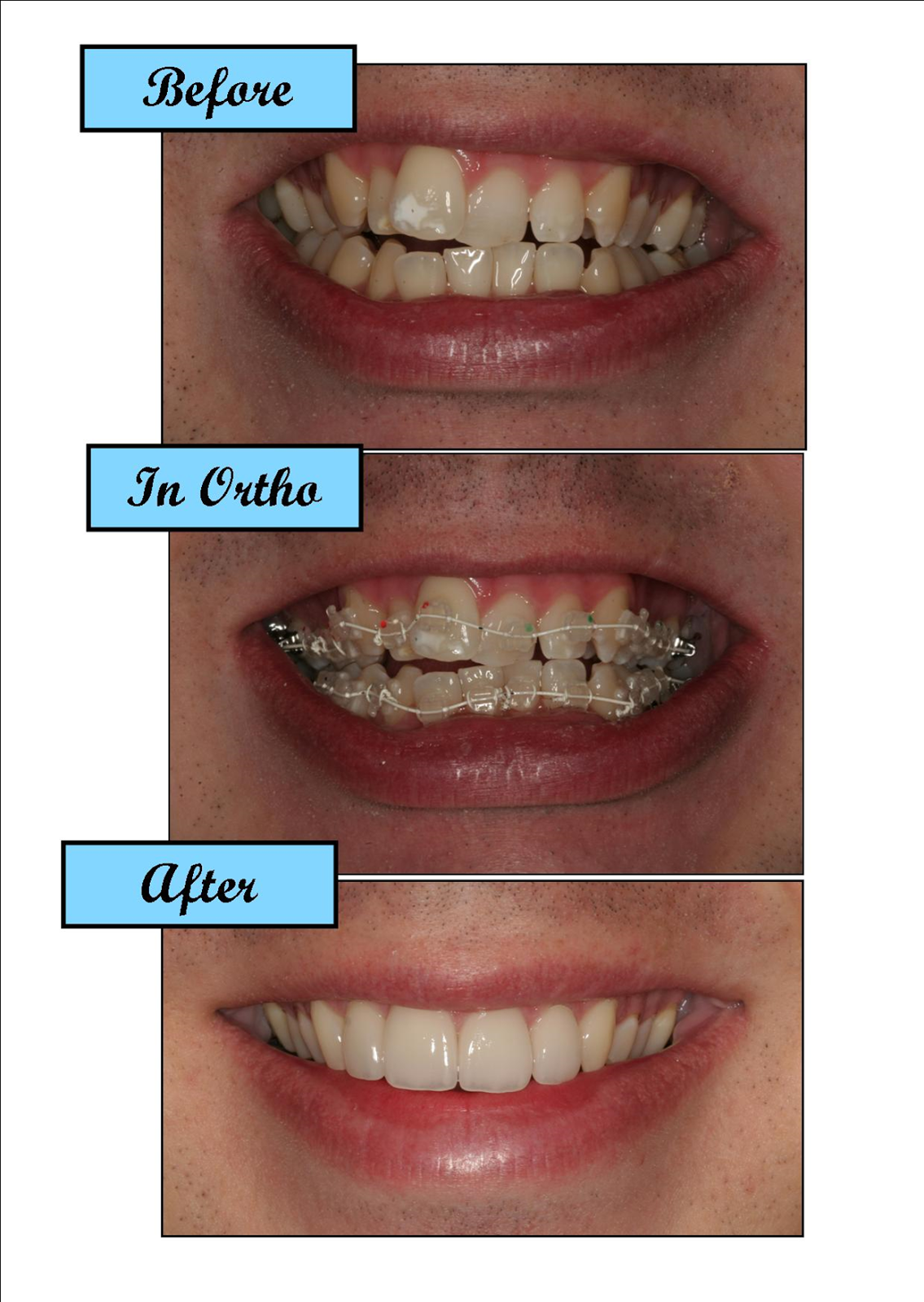 Dentist Orlando Florida Six Months Smiles Cosmetic Braces System
