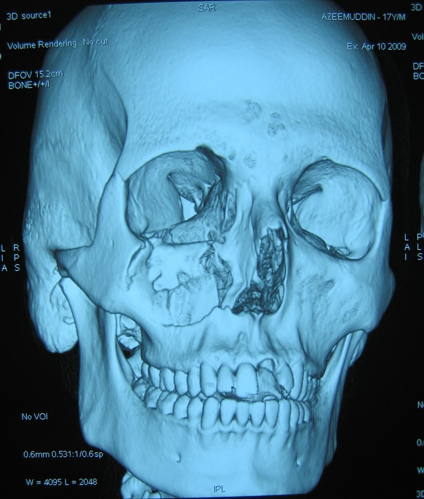facial injuries orbit blowout close facial injuries orbit blowout negligible