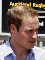 Prince William baldness