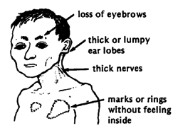 Microamaze: Lepromatous leprosy