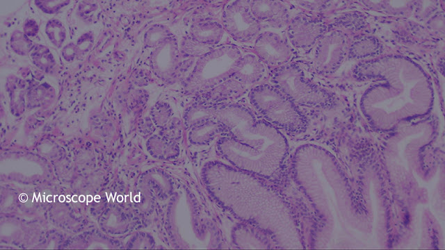 Villous Adenoma under the microscope at 100x. Villous Adenoma under the microscope at 100x.