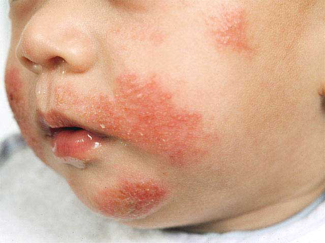 atopic eczema baby 2 penyebab penyakit kulit penyakit pada kulit penyakit kulit psoriasis penyakit kulit 