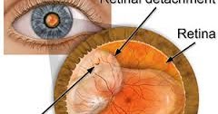 webmd detached retina symptoms webmd detached retina symptoms