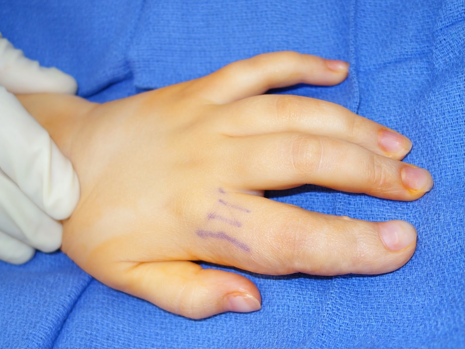 Macrodactyly/ Large digits Congenital Hand and Arm Differences