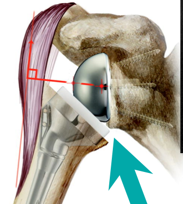 Image result for Instability After Reverse Total Shoulder Arthroplasty