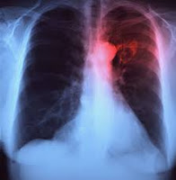 Embolia pulmonar (EP ) es una enfermedad muy común y altamente letal que es la principal causa de muerte en todos los grupos de edad.