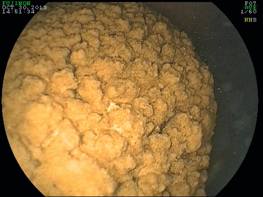 Michael Porter, Equine Veterinarian Urinary Bladder Stone in a Horse