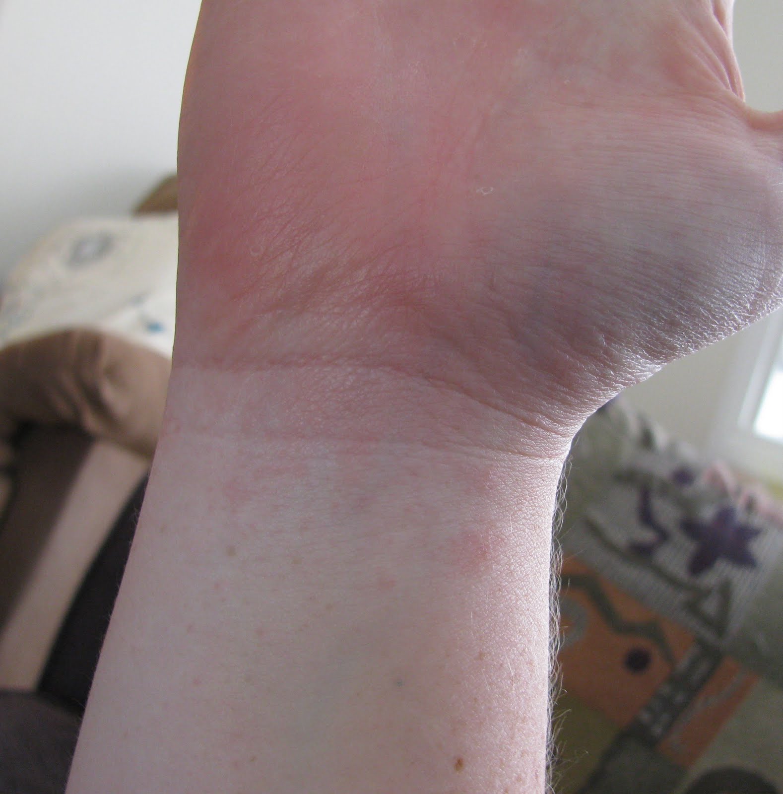 List 92+ Pictures Pictures Of Dyshidrotic Eczema On Hands Updated 10/2023