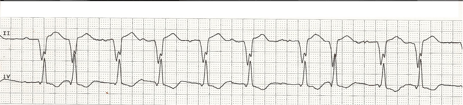 Atrial Pacemaker Rhythm