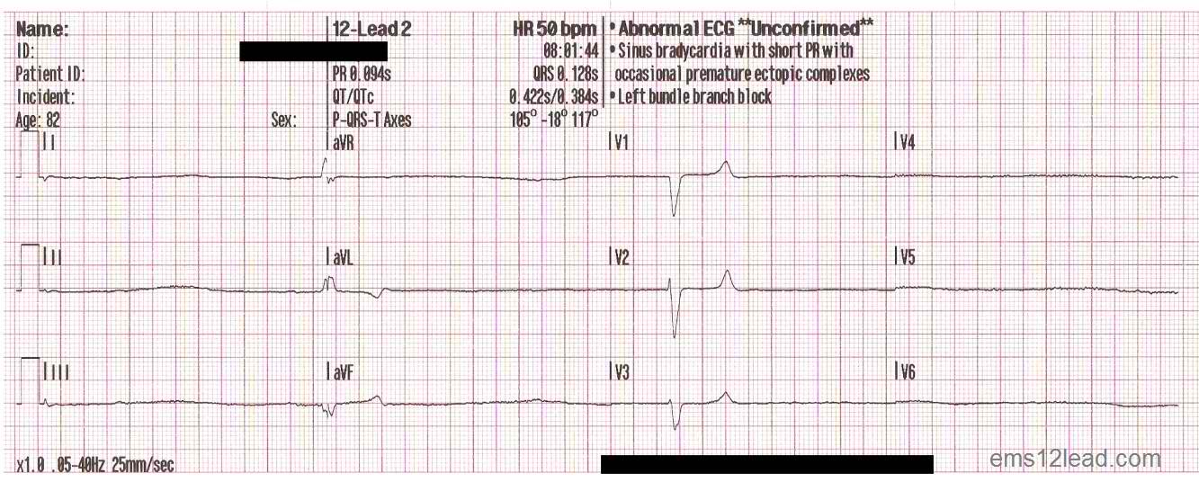 EMS 12 Lead Bradycardia Post Part II