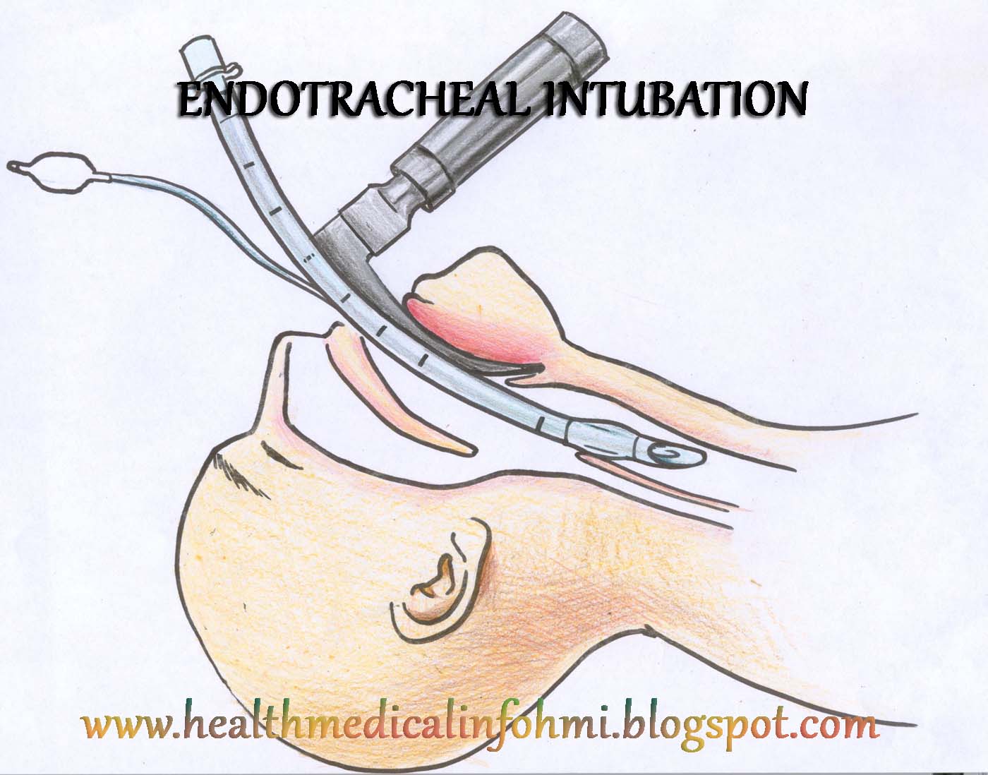 Health and Medical Information (HMI) Endotracheal Intubation