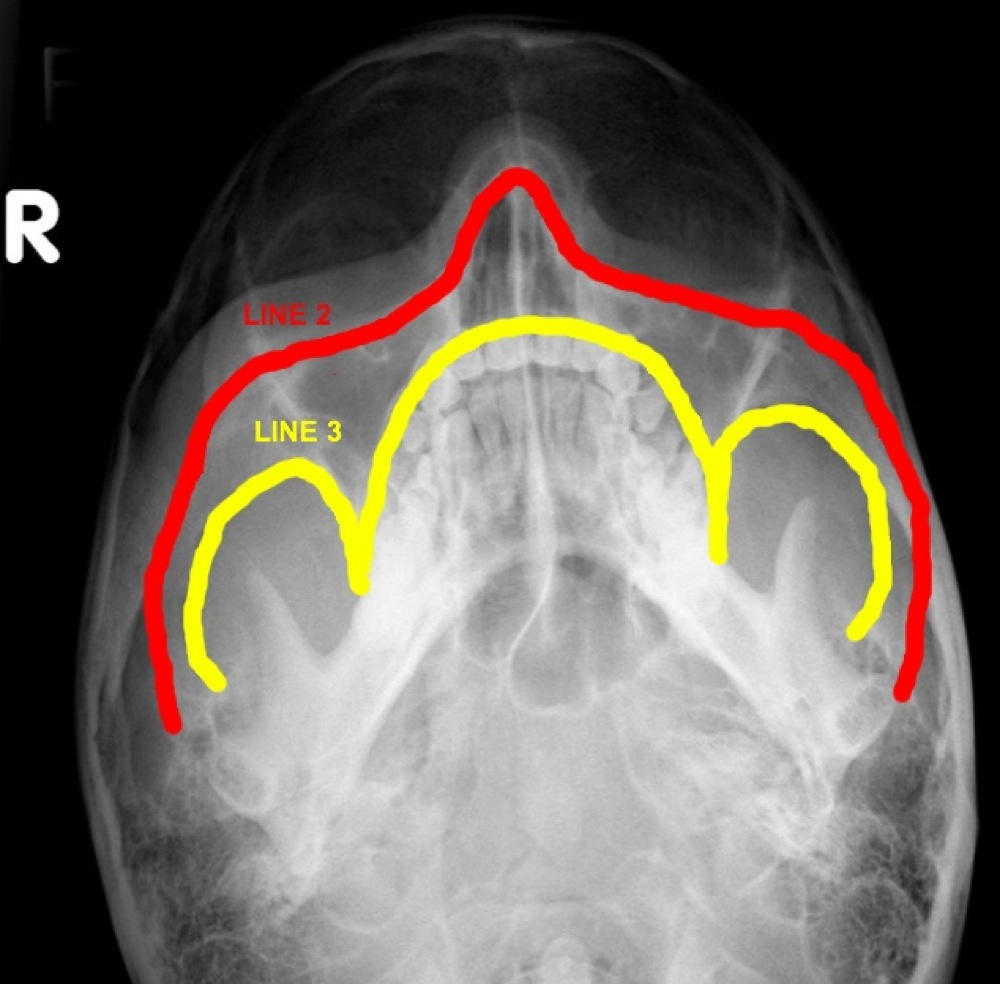 ON RADIOLOGY What are Occipitomental Views ? And lines for inspection.