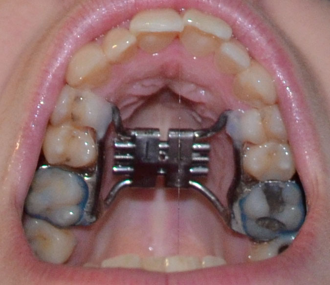 expander sarpe spacer amy adventure went