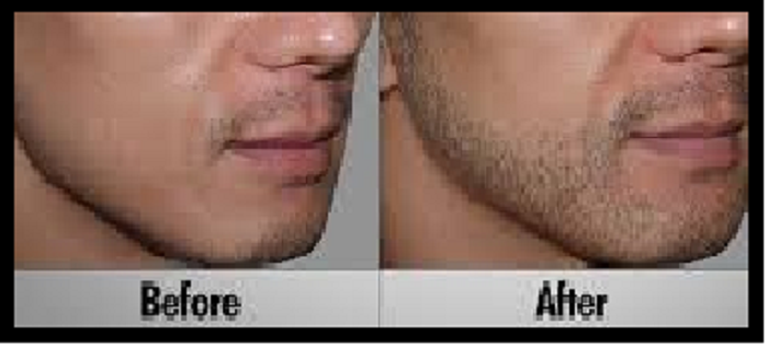 Blessing Hair Transplant Center Beard Hair Transplant In Ludhiana