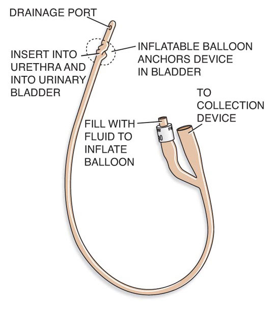 Bladder filling catheter