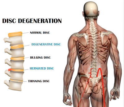  Common Spinal Conditions & Symptoms