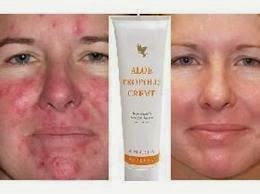 forever Aloe Propolis creme corrects all form of skin  infections including acne, eczema