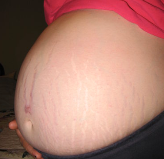 pregnancy stretch marks pregnancy stretch marks