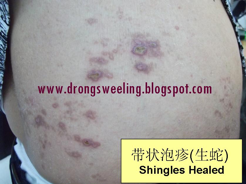 TCM News Shingles (Herpes Zoster)带状疱疹(生蛇)